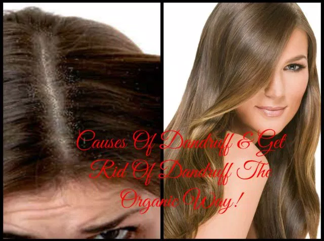 get-rid-of-dandruff-naturally-healthy-hair